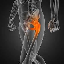 hip replacement story starting with arthritis