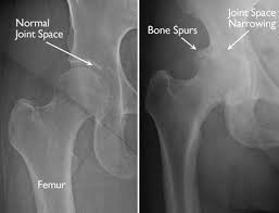 Middle age arthritis caused by bone spur rubbing the cartilage away