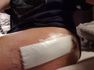Hip replacement surgery scar, hidden under the waterproof dressing and pre-bruising