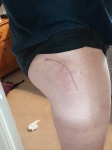 Hip replacement scar