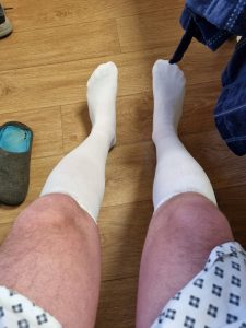 Stockings following functional endoscopic sinus surgery for sense of smell loss